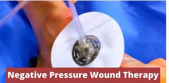 Cpt code wound vac placement