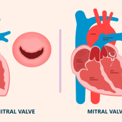 Aortic regurgitation hesi case study